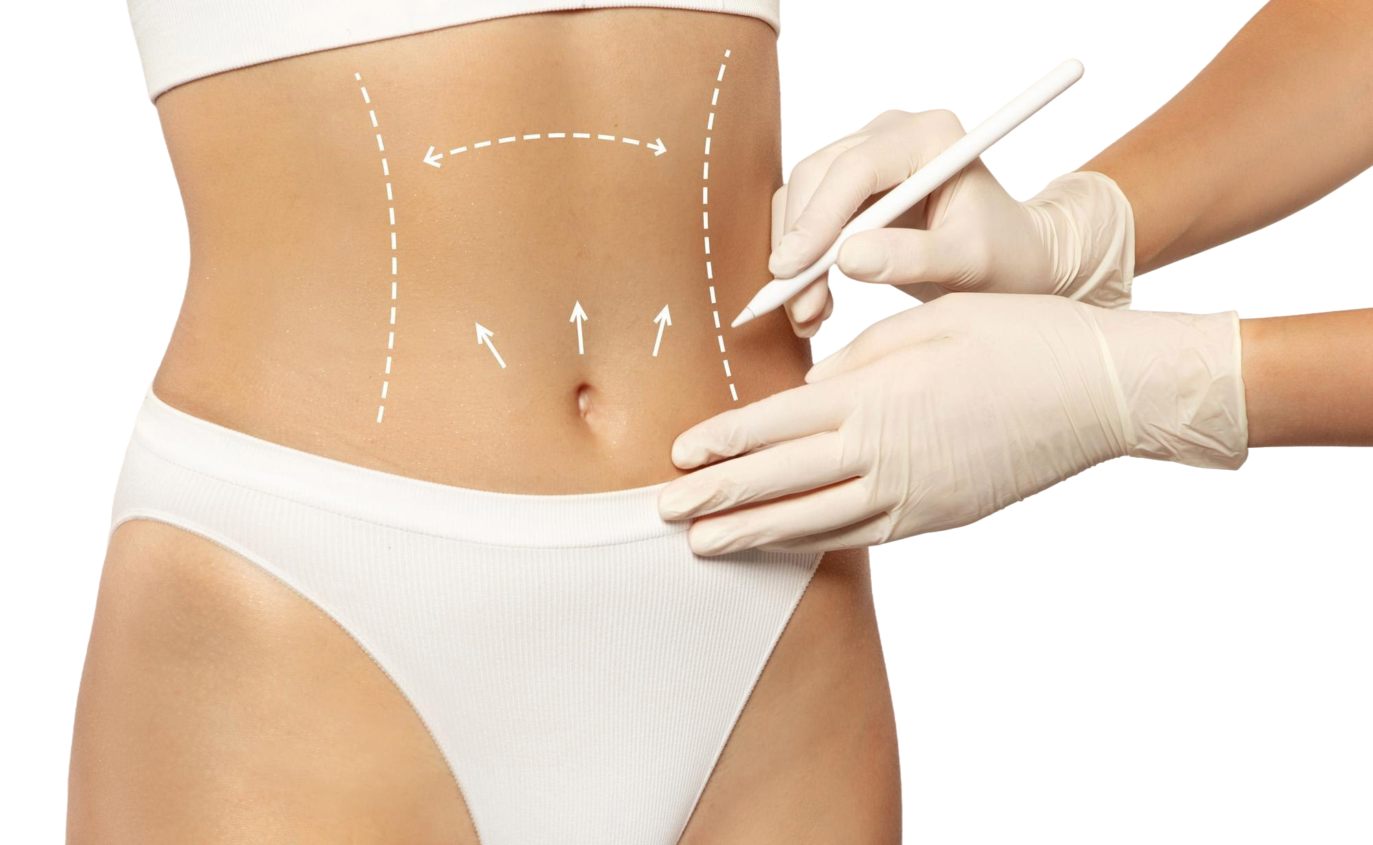 Abdominoplastia